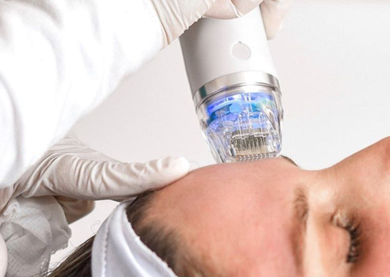 Microneedling Treatment